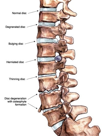 Low Back Pain - Docmuscles